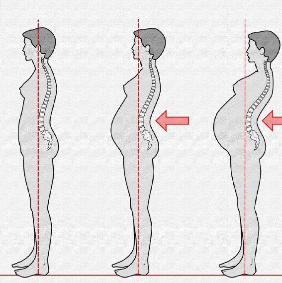 Técnica ajuda a corrigir a postura após a gravidez